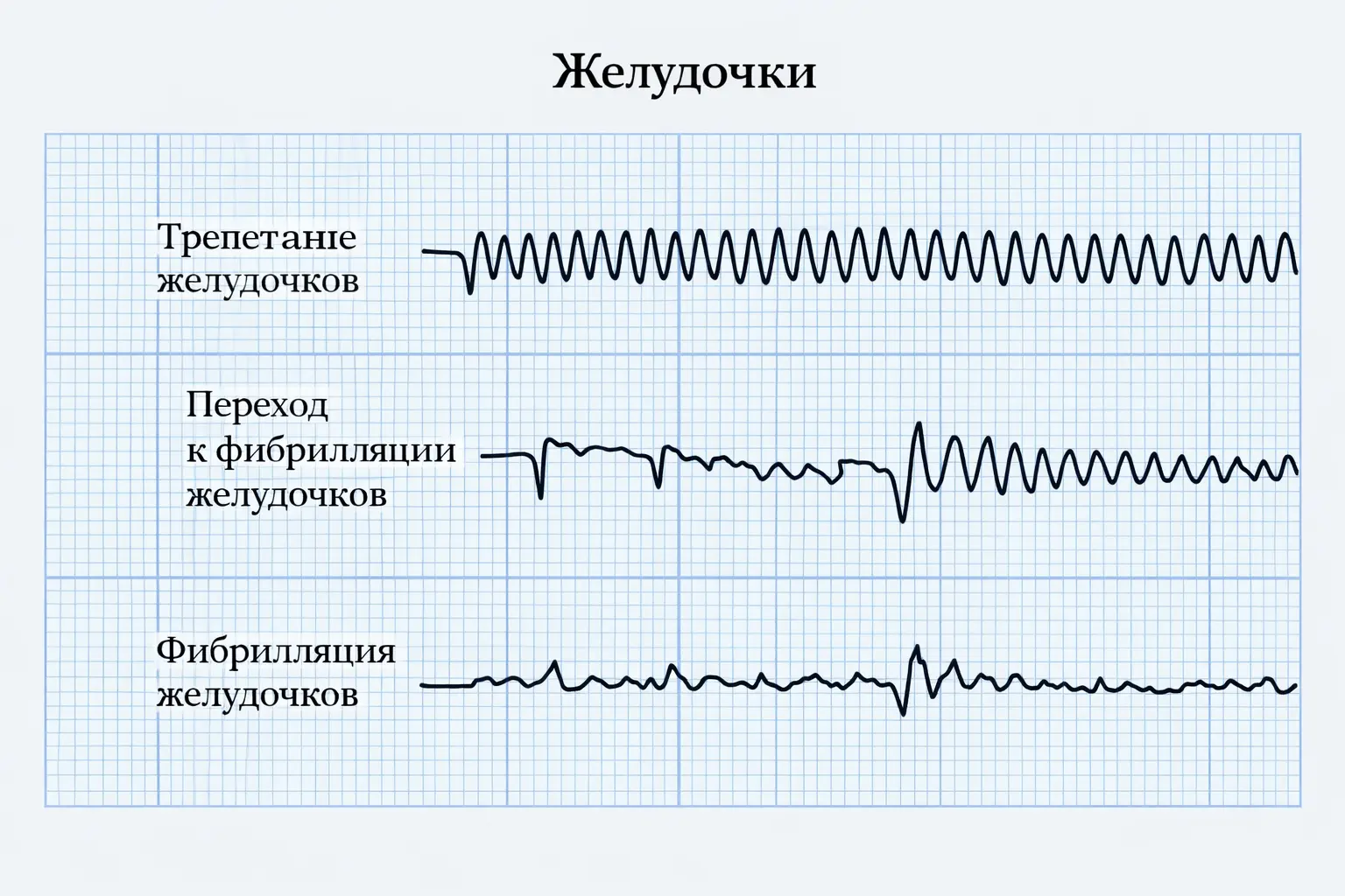 Трепетание и фибрилляция